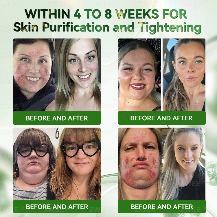 𝗭𝐖𝗘𝐄®🏅𝑮𝑳𝑷-1 7-𝑫𝒂𝒚 𝑮𝒖𝒕 𝑪𝒍𝒆𝒂𝒏𝒔𝒆 & 𝑺𝒍𝒊𝒎 𝑺𝒖𝒑𝒑𝒐𝒓𝒕 𝑶𝒓𝒂𝒍 𝑺𝒐𝒍𝒖𝒕𝒊𝒐𝒏-(𝐎𝐧𝐜𝐞 𝐚 𝐝𝐚𝐲, 𝐫𝐞𝐬𝐮𝐥𝐭𝐬 𝐢𝐧 𝟕 𝐝𝐚𝐲𝐬), 𝑾𝒊𝒕𝒉 10 𝑩𝒊𝒍𝒍𝒊𝒐𝒏 𝑪𝑭𝑼 𝑨𝒄𝒕𝒊𝒗𝒆 𝑷𝒓𝒐𝒃𝒊𝒐𝒕𝒊𝒄𝒔, 𝑺𝒖𝒑𝒑𝒐𝒓𝒕𝒔 𝒘𝒆𝒊𝒈𝒉𝒕 𝒎𝒂𝒏𝒂𝒈𝒆𝒎𝒆𝒏𝒕, 𝒉𝒆𝒂𝒓𝒕 𝒉𝒆𝒂𝒍𝒕𝒉, 𝒅𝒊𝒂𝒃𝒆𝒕𝒆𝒔, 𝒈𝒖𝒕 & 𝒘𝒐𝒎𝒆𝒏'𝒔 𝒉𝒆𝒂𝒍𝒕𝒉, 𝒇𝒊𝒓𝒎𝒊𝒏𝒈 𝒔𝒌𝒊𝒏,𝒘𝒉𝒊𝒍𝒆 𝒔𝒆𝒂𝒔𝒐𝒏𝒂𝒍 𝒊𝒎𝒎𝒖𝒏𝒆 𝒔𝒖𝒑𝒑𝒐𝒓𝒕